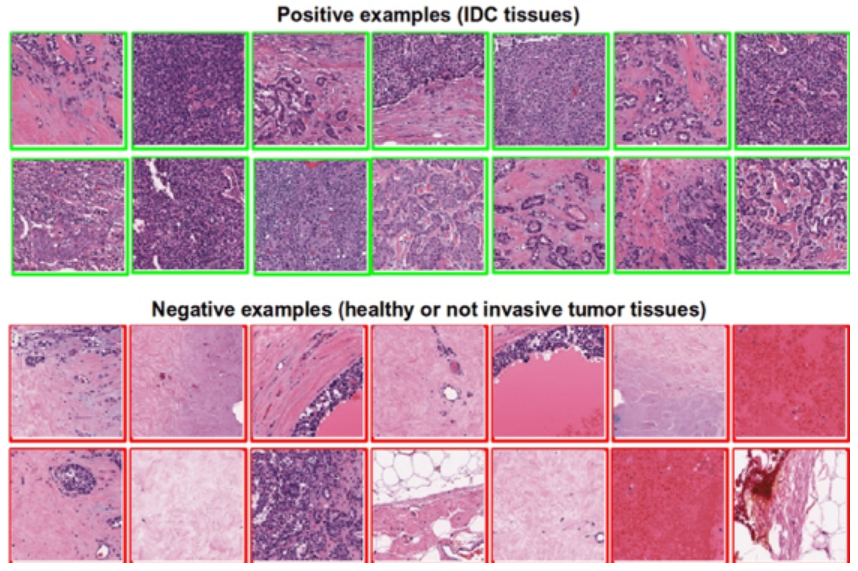 Beginner Level Data Science Projects Breast Cancer Detection and Classification